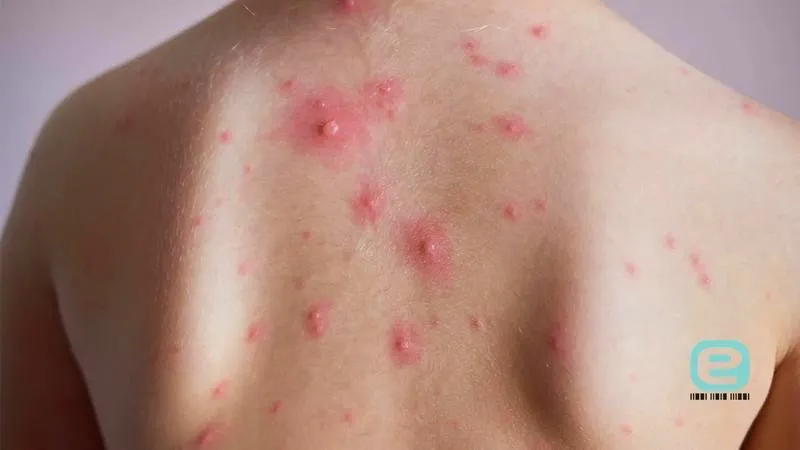 Czy dziecko z ospą w przedszkolu - co warto wiedzieć przed powrotem?
