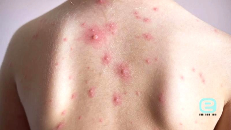 Ospa: czy po pojawieniu się strupów dziecko nadal zaraża? Powrót do przedszkola