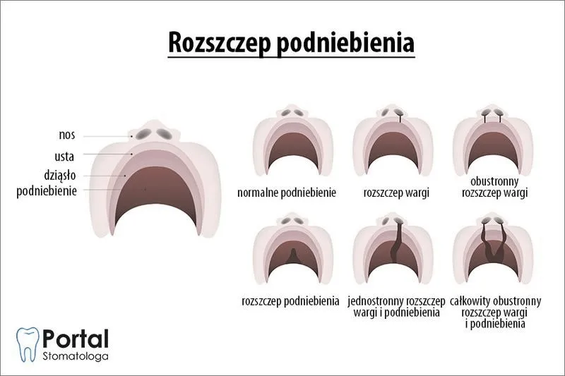 Wyraźna mowa po rozszczepie — ćwiczenia logopedyczne krok po kroku dla rodziców i terapeutów