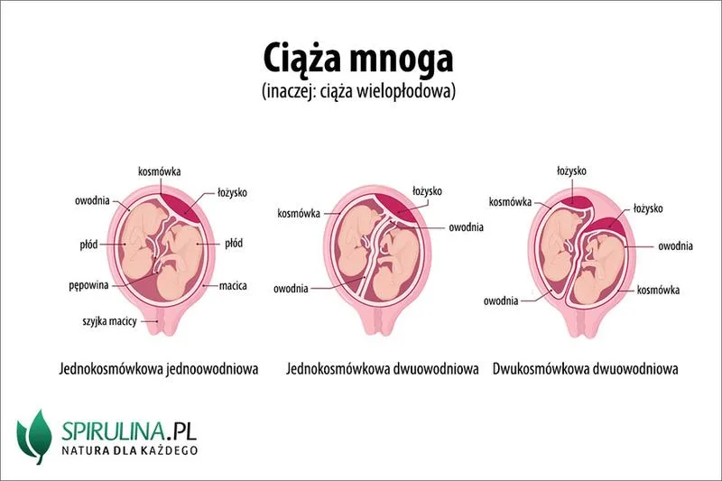 Ciąża bliźniacza