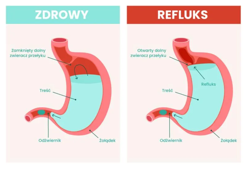 Metody łagodzenia refluksu