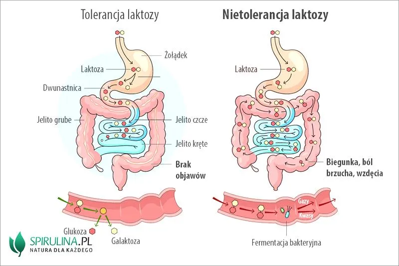 Nietolerancja laktozy