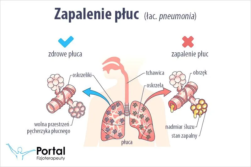 Objawy zapalenia płuc