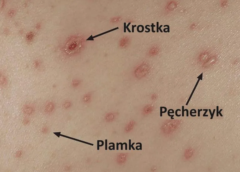 Ospą w przedszkolu