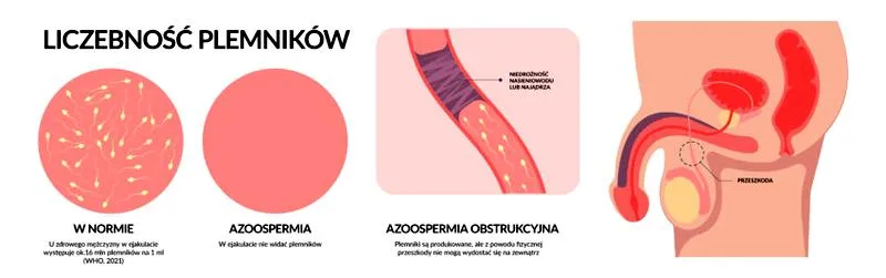Przyczyny braku plemników