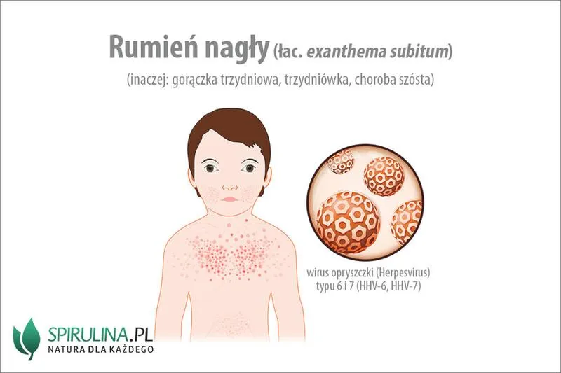 Rumień u dziecka